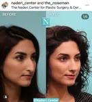 middle-easter-rhinoplasty-patient-920x1024.jpg middle-easter-rhinoplasty-patient-920x1024.jpg